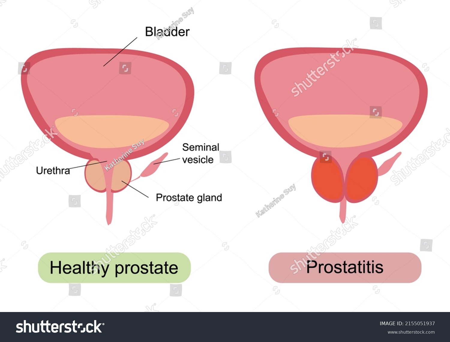 Male Healthy Unhealthy Prostate Prostatic Hypertrophy Stock ...