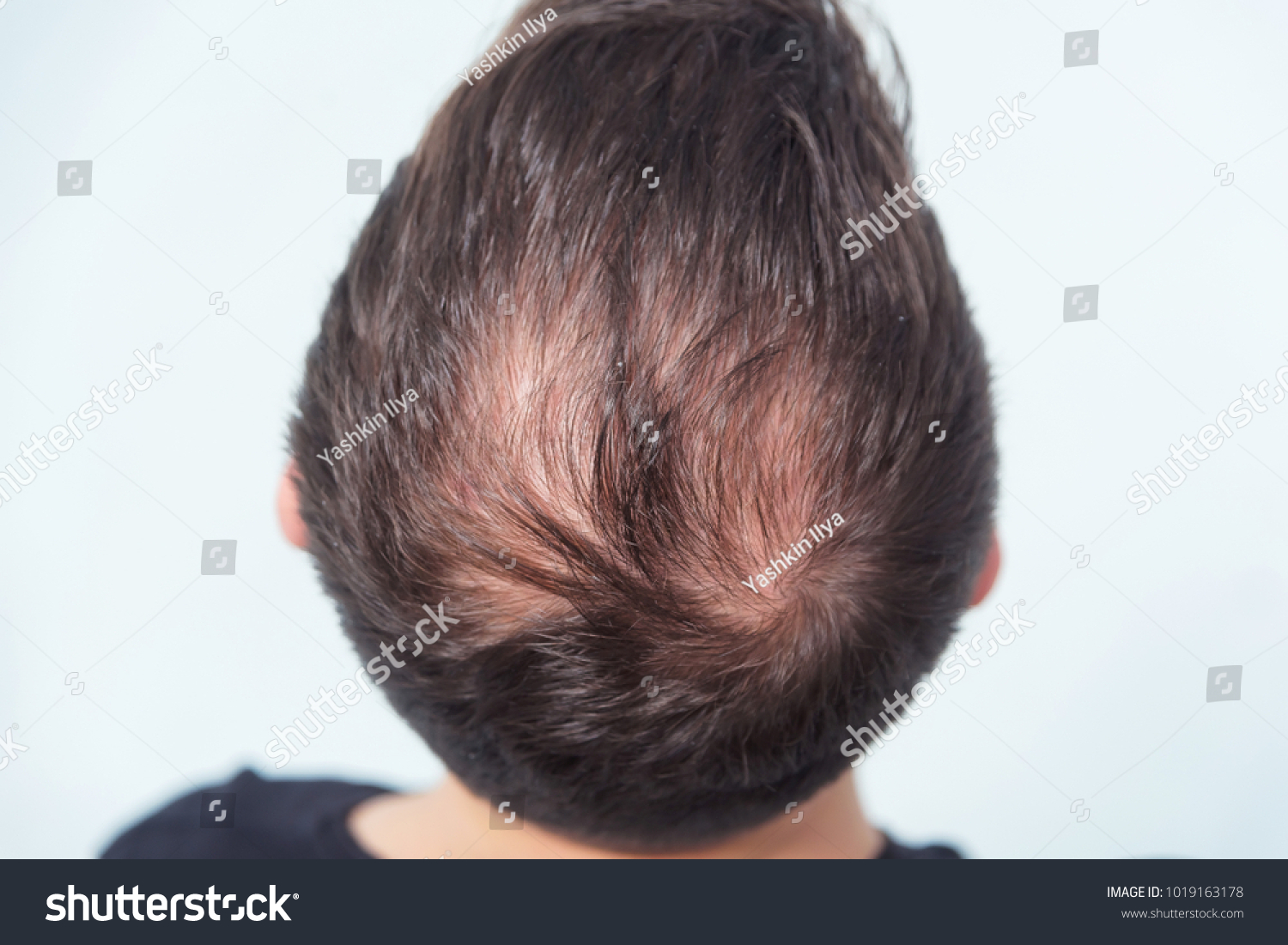 Male Pattern Baldness Hair Loss Early Stock Image Download Now