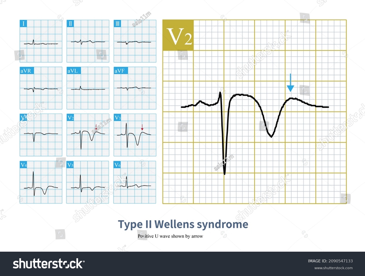 Male 44 Years Old Chest Pain Stock Illustration 2090547133