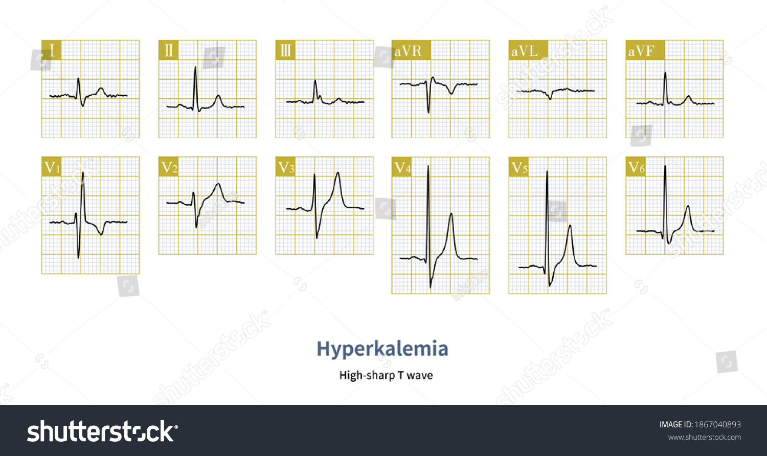 Hyperkalemia Images, Stock Photos & Vectors | Shutterstock