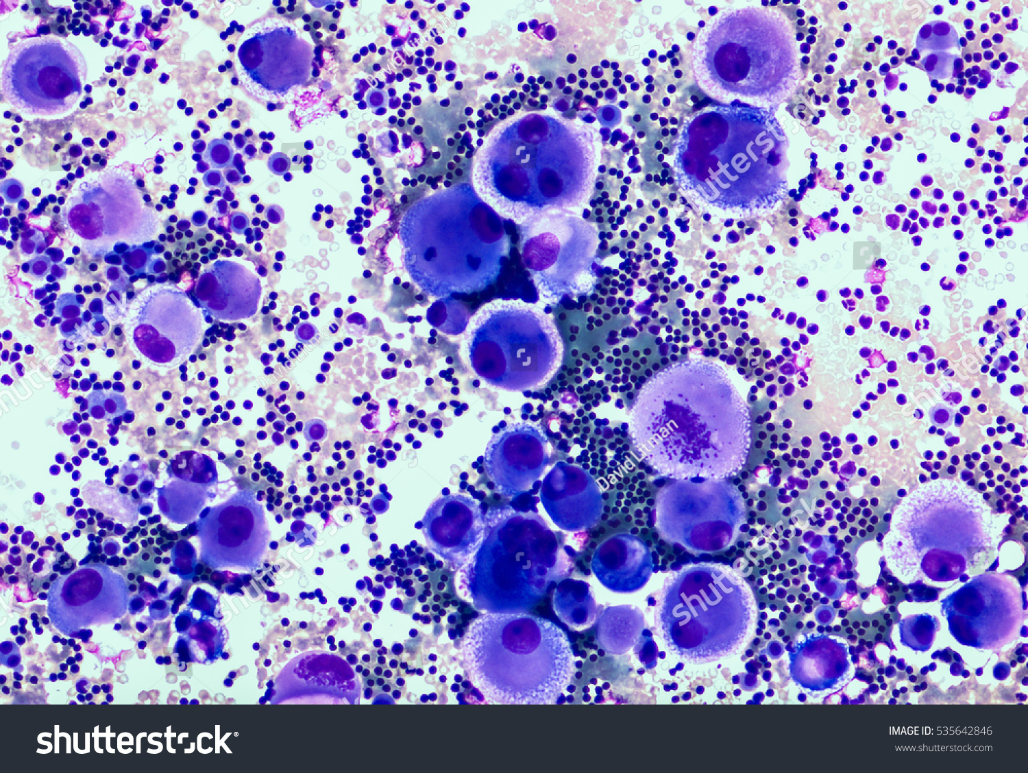 Signet Ring Cell Peritoneal Fluid