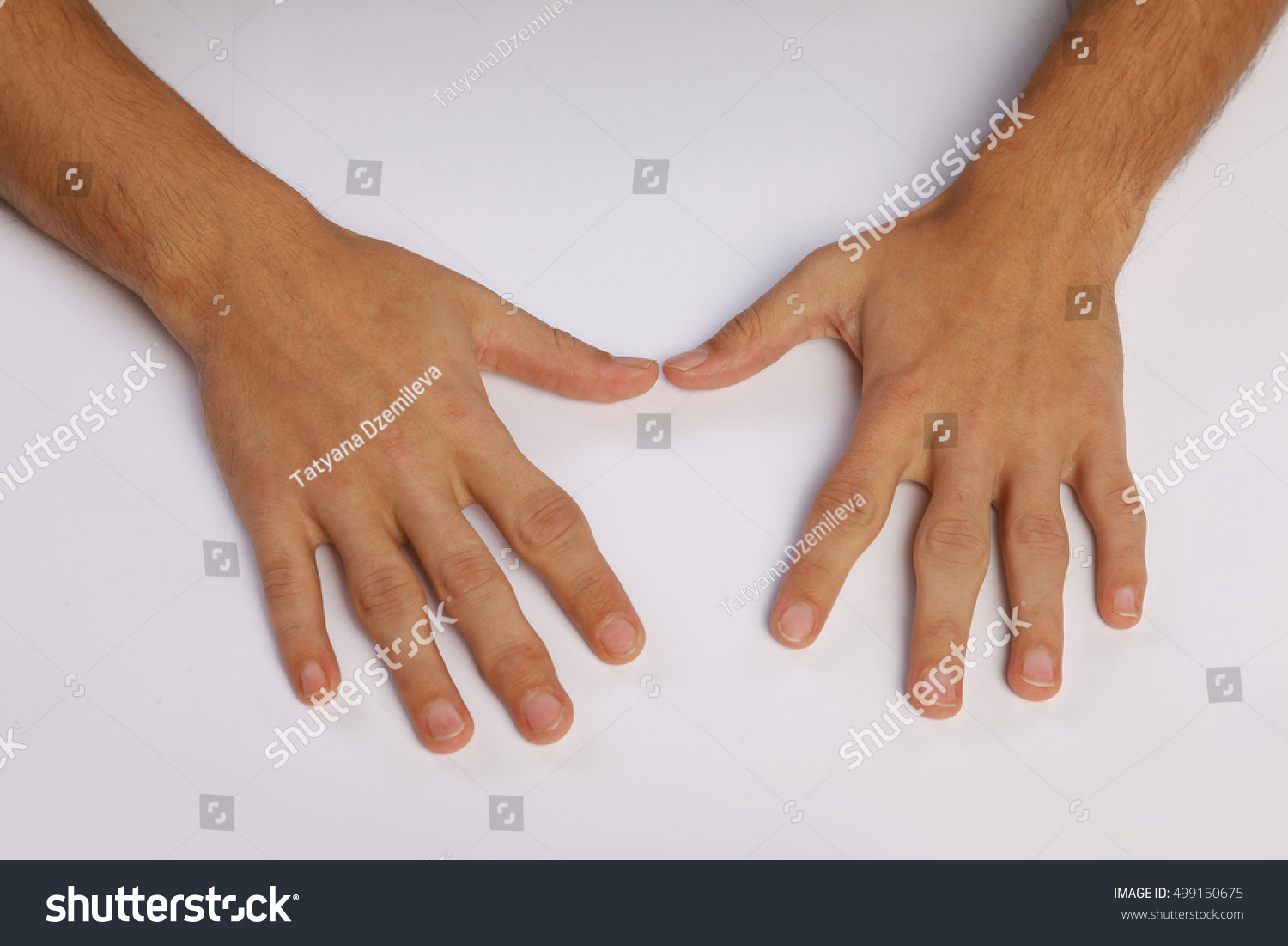 Mans Hands Deformed Rheumatoid Arthritis Stock Photo Shutterstock