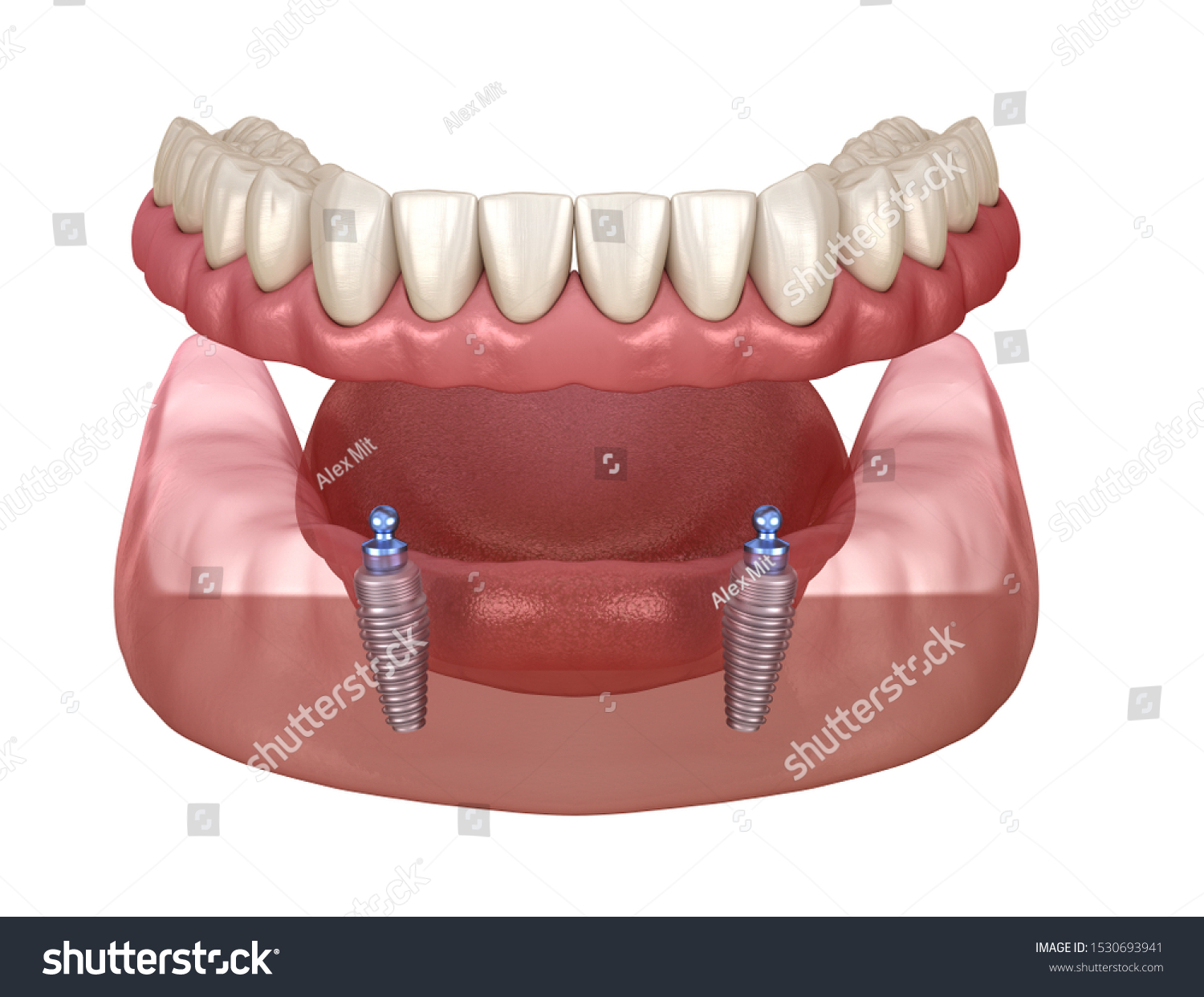 Ilustrasi Stok Mandibular Removable Prosthesis All On 2 1530693941 ...