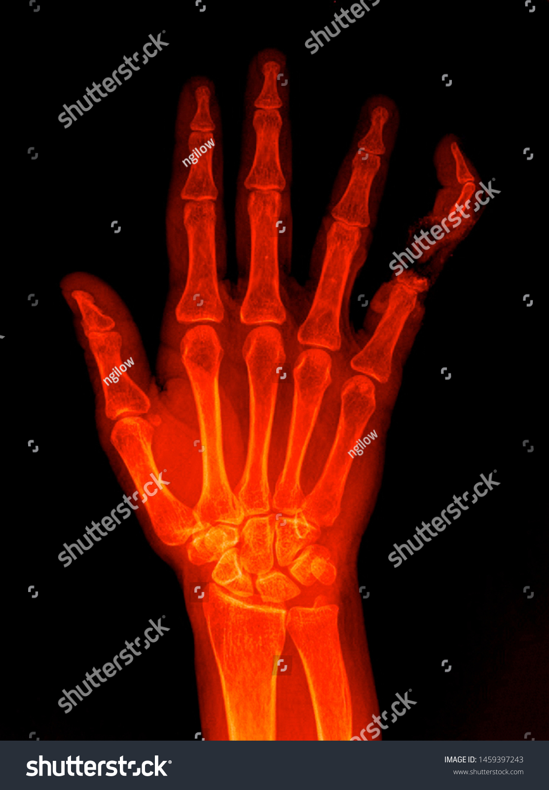 Manus X Ray Anatomy Radiology Radiographic Stock Photo 1459397243 ...