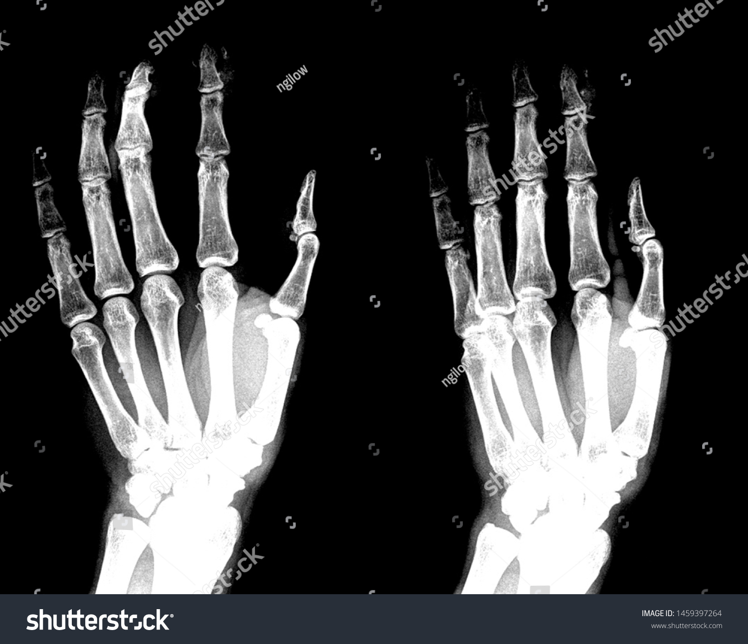 Manus X Ray Anatomy Radiology Radiographic Stock Photo 1459397264 ...