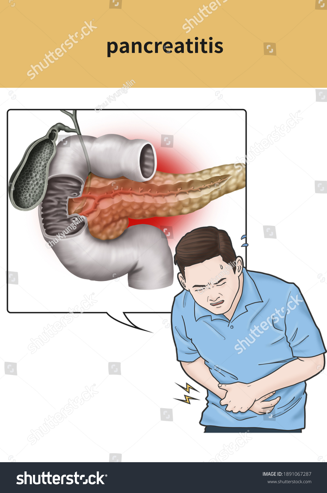 Medical Illustration Explanation Pancreatitis Stock Illustration ...