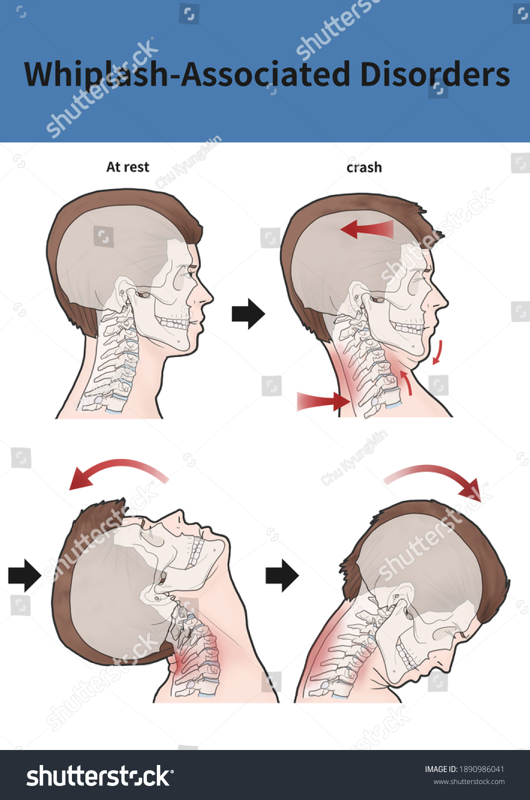 Medical Illustration Explanation Whiplashassociated Disorders Stock ...