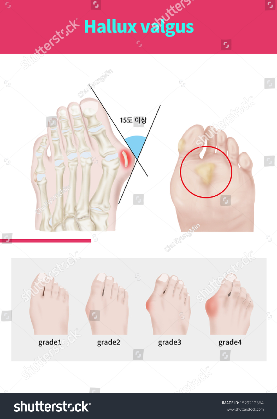 Medical Illustration Explain Hallux Valgus Ilustraci N De Stock