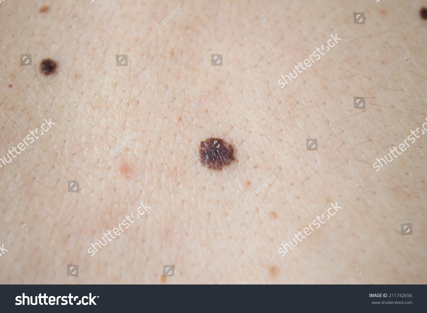 Melanoma, Skin Cancer, On Back Of A Man Stock Photo 211742656 ...