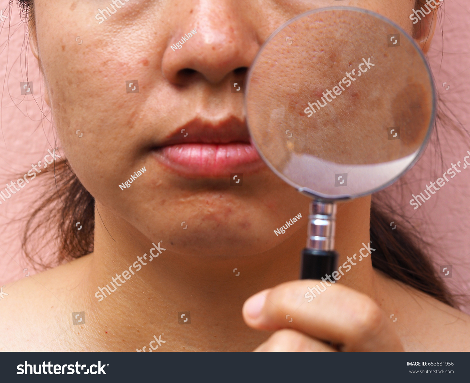 Melasma Skin Magnifying Glass On Woman Stock Photo Edit Now
