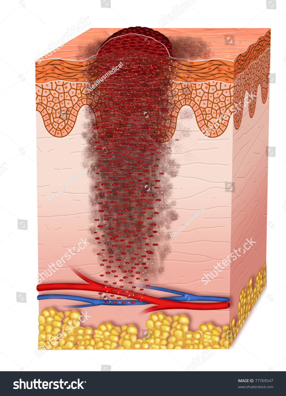 Metastasis Melanoma Stock Photo 77769547 : Shutterstock