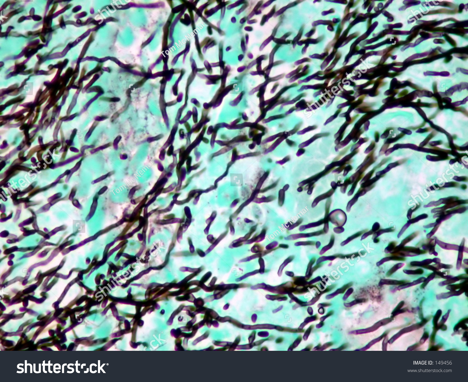 Microphotograph Of Fungal Organisims In Human Tissue. Stock Photo ...