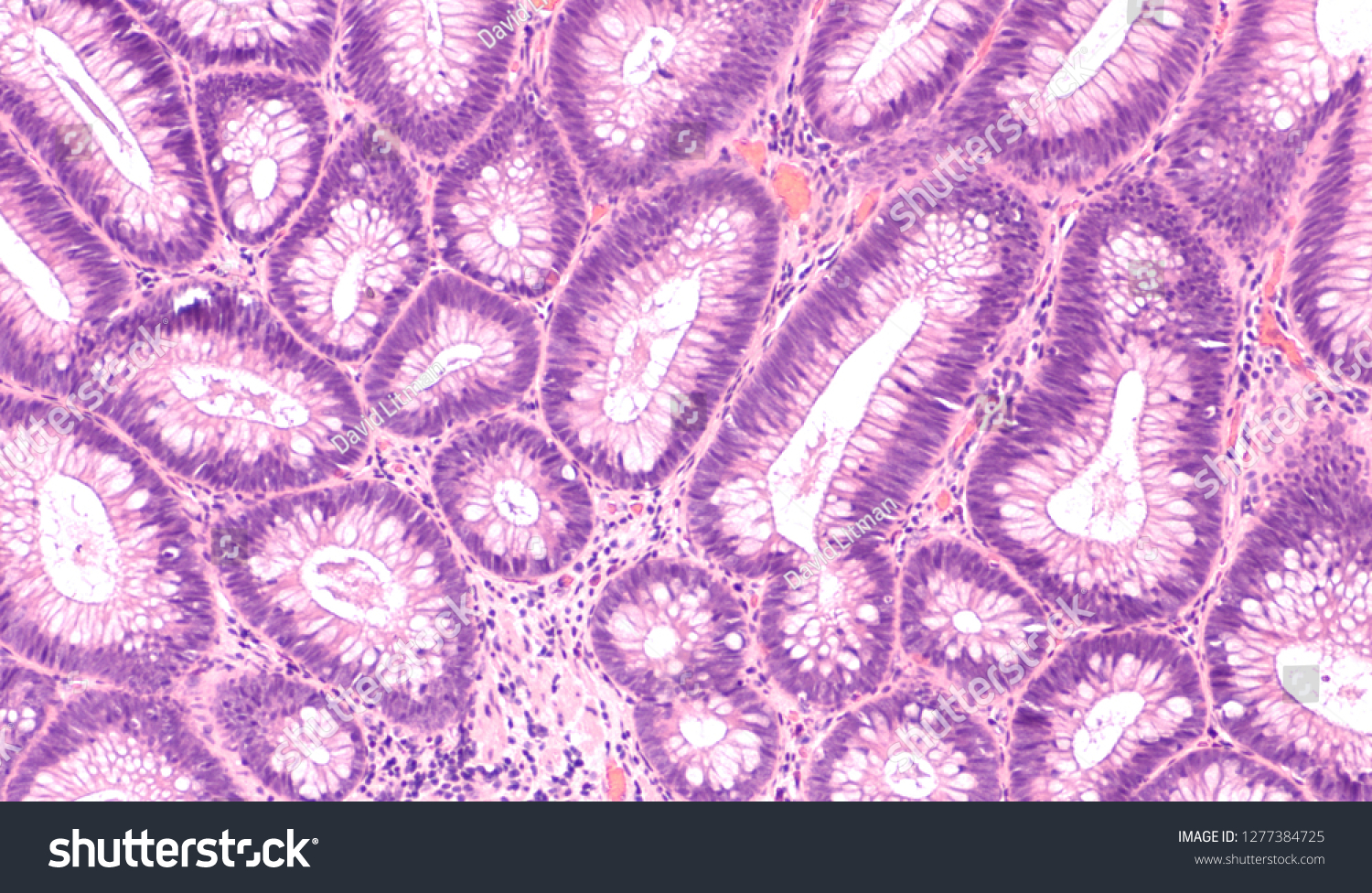 Tubular Adenoma Histology 3295