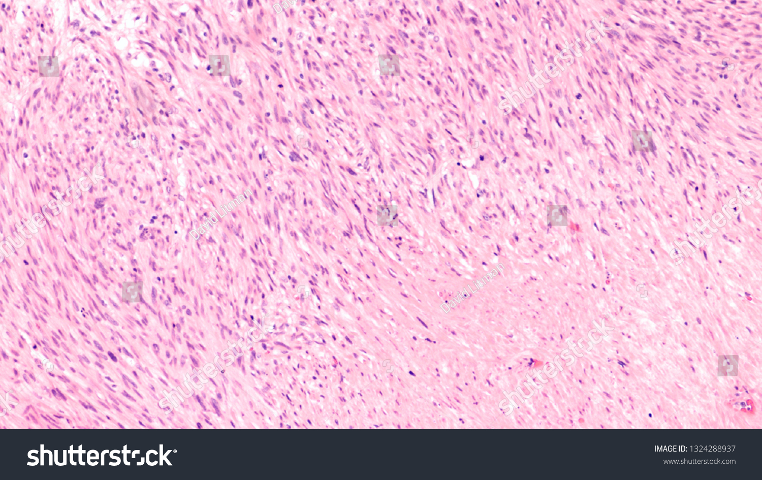 Microscopic Image Leiomyosarcoma Type Soft Tissue Stock Photo (edit Now 