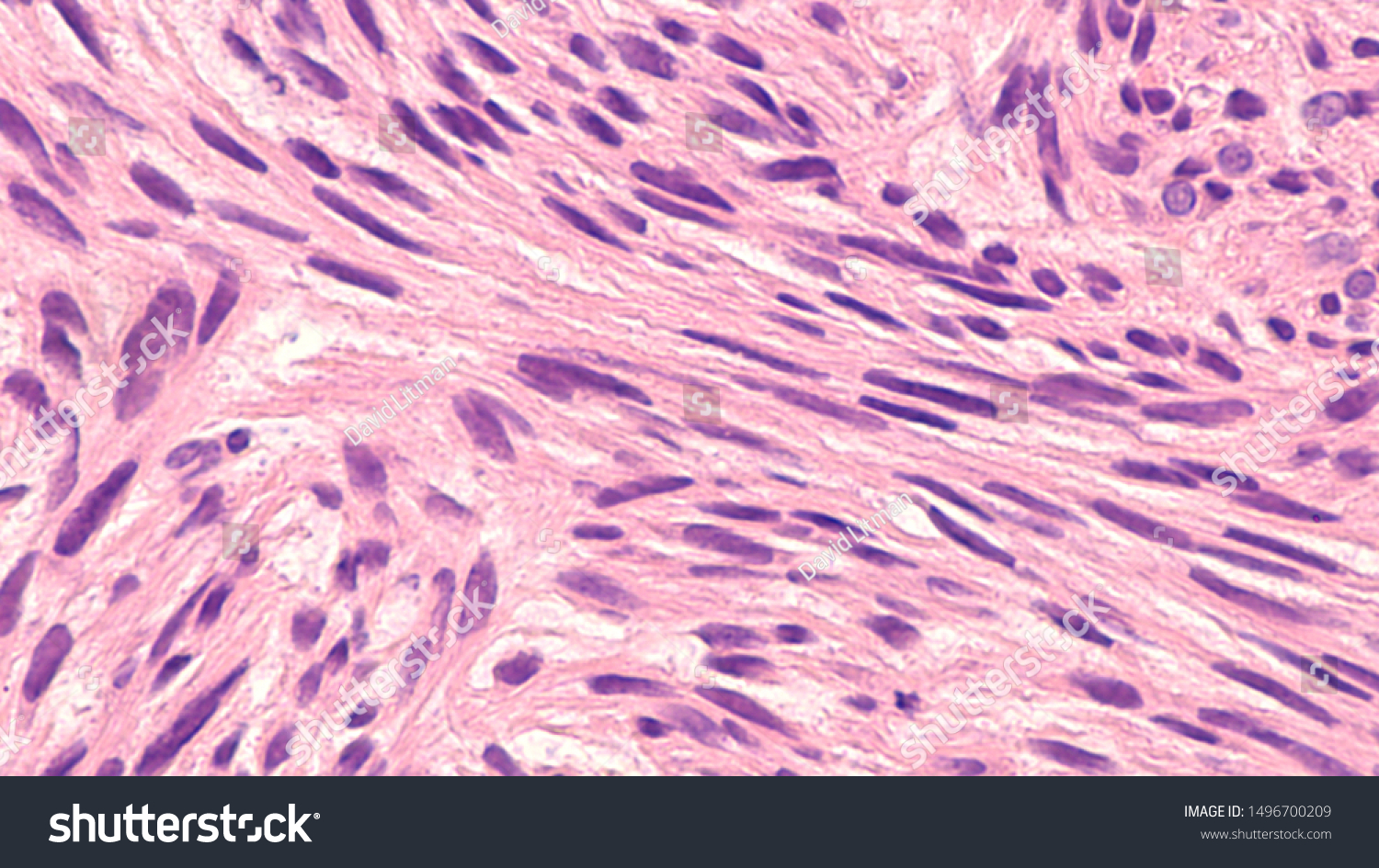 Microscopic Image Leiomyosarcoma Type Soft Tissue Stock Photo ...