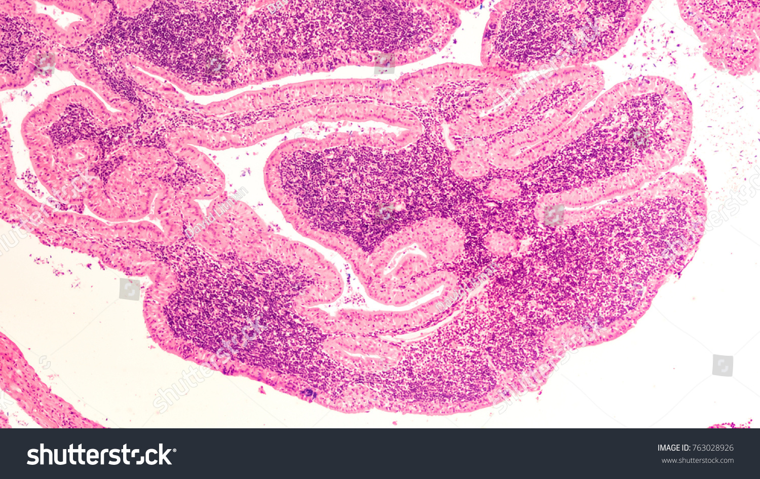 Microscopic Image Warthins Tumor Benign Tumor 库存照片 立即编辑 763028926