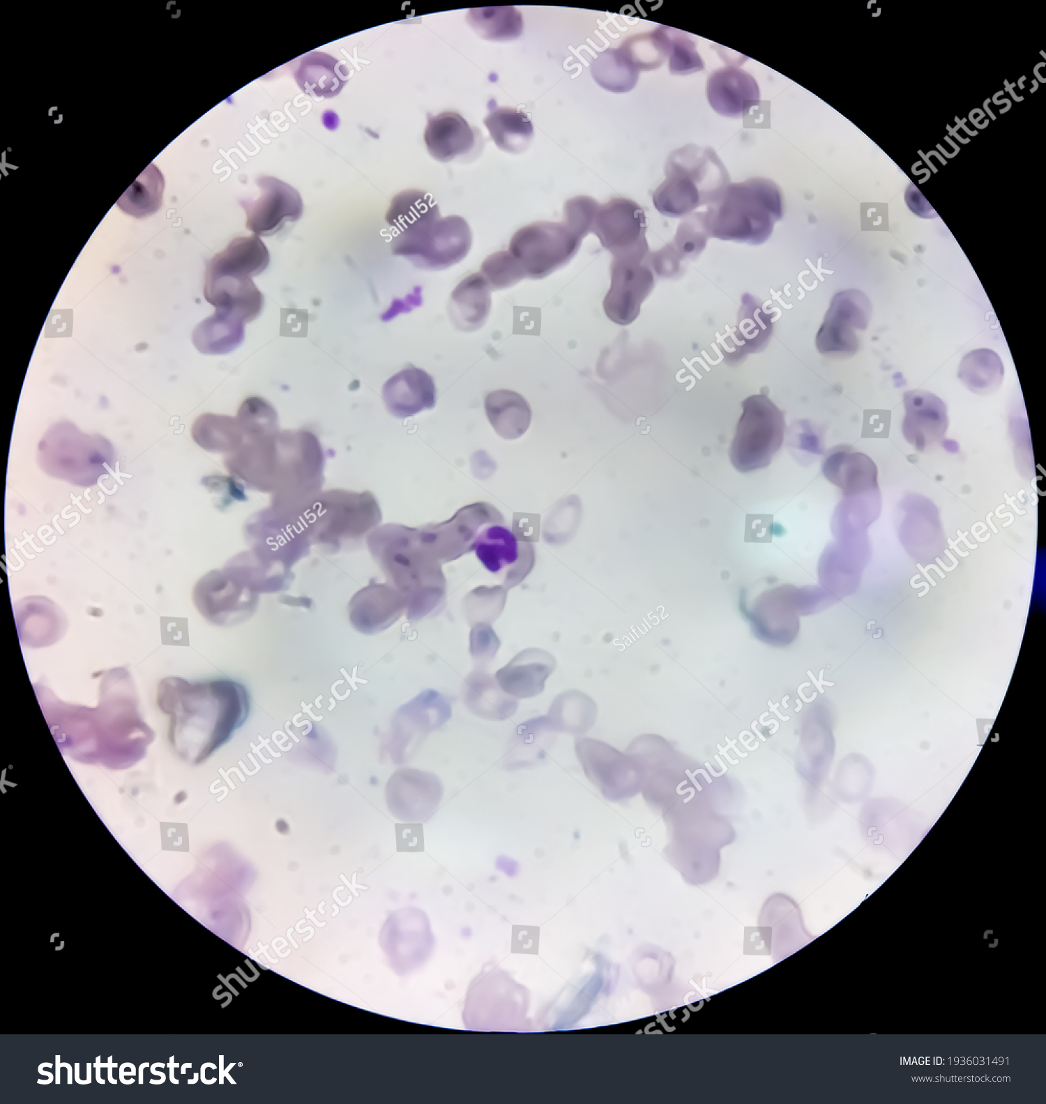 Microscopic View Cold Agglutinin Disease Cad Stock Photo (Edit Now ...