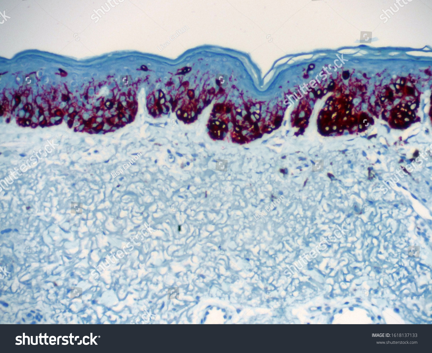 19 Melanoma situ Images, Stock Photos & Vectors | Shutterstock