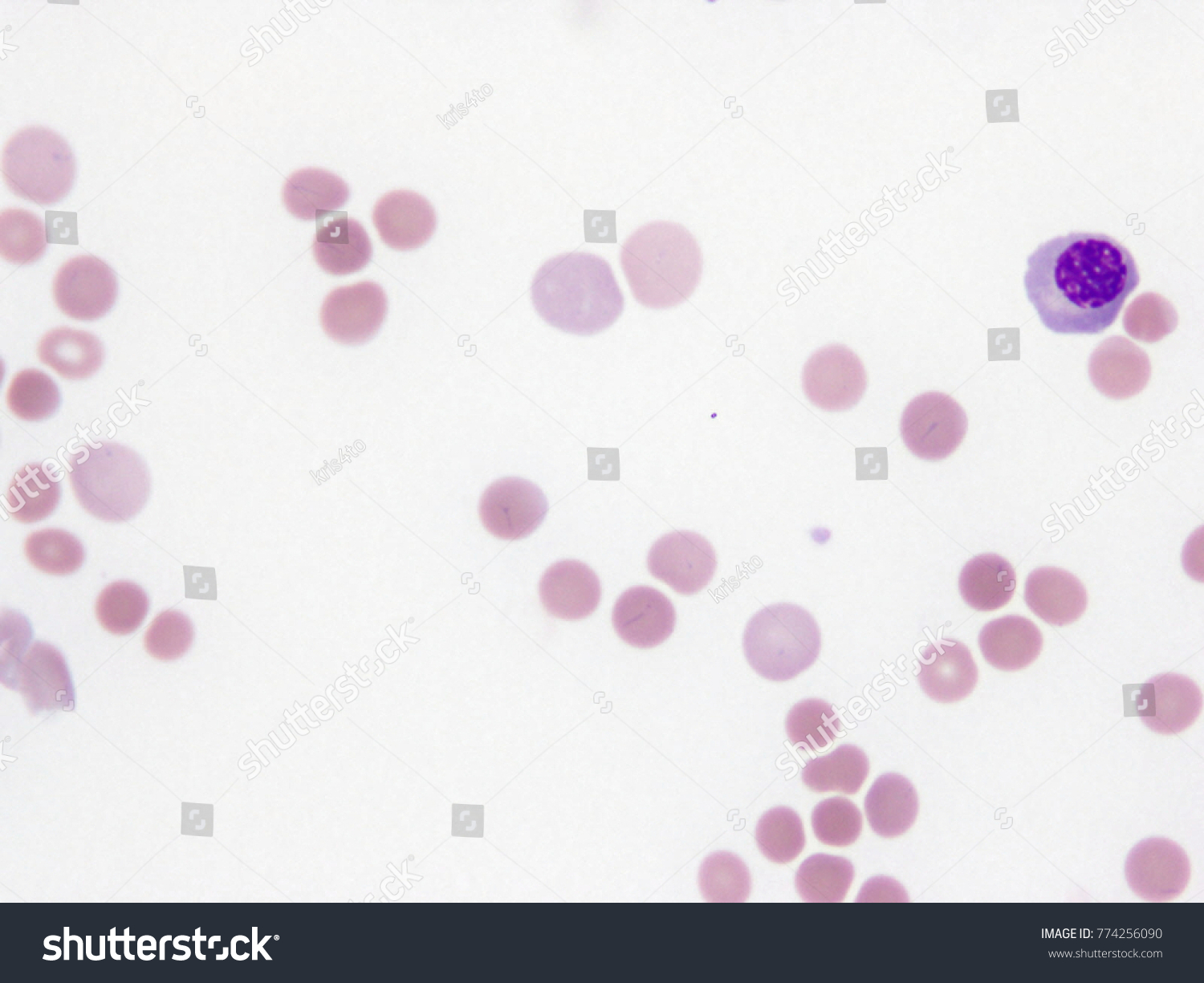 Microspherocytes On Peripheral Blood Smear Autoimmune Stock Photo