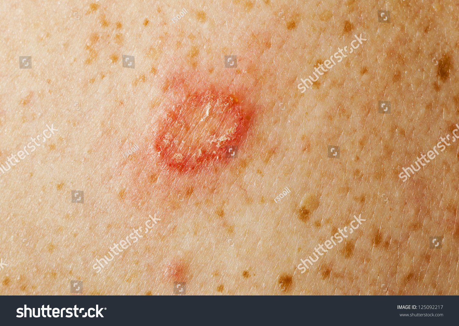 Microsporia Fungus Stock Photo 125092217 - Shutterstock