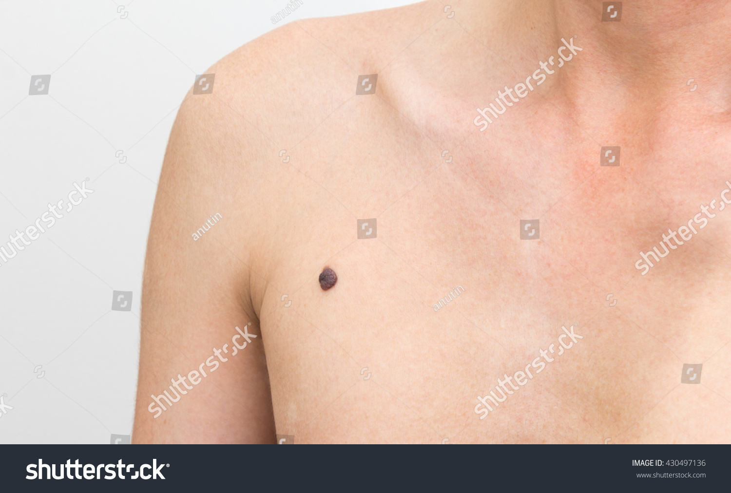 what-is-involved-in-removing-an-armpit-mole-with-pictures