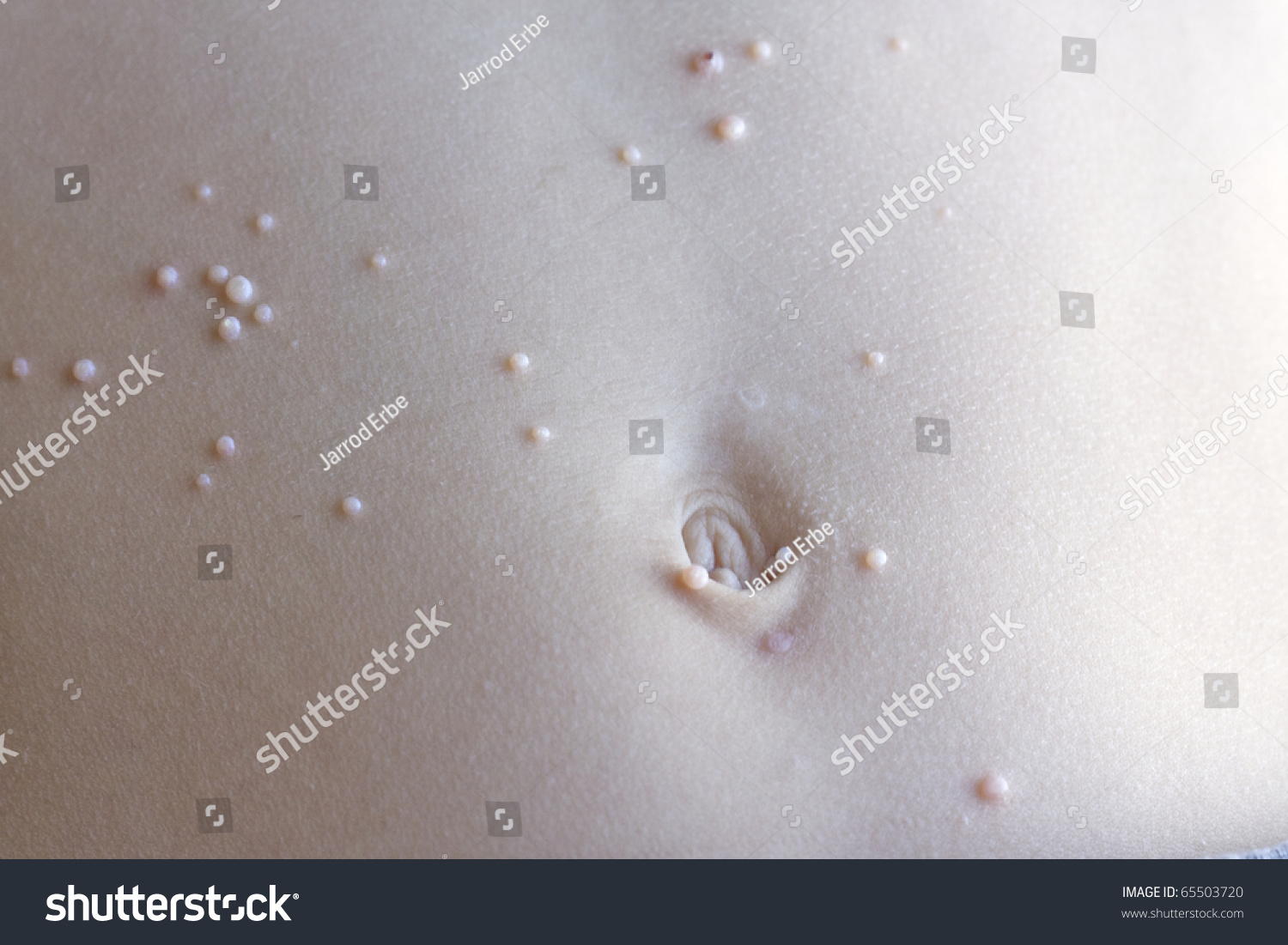 Bumps On Child S Skin Virus