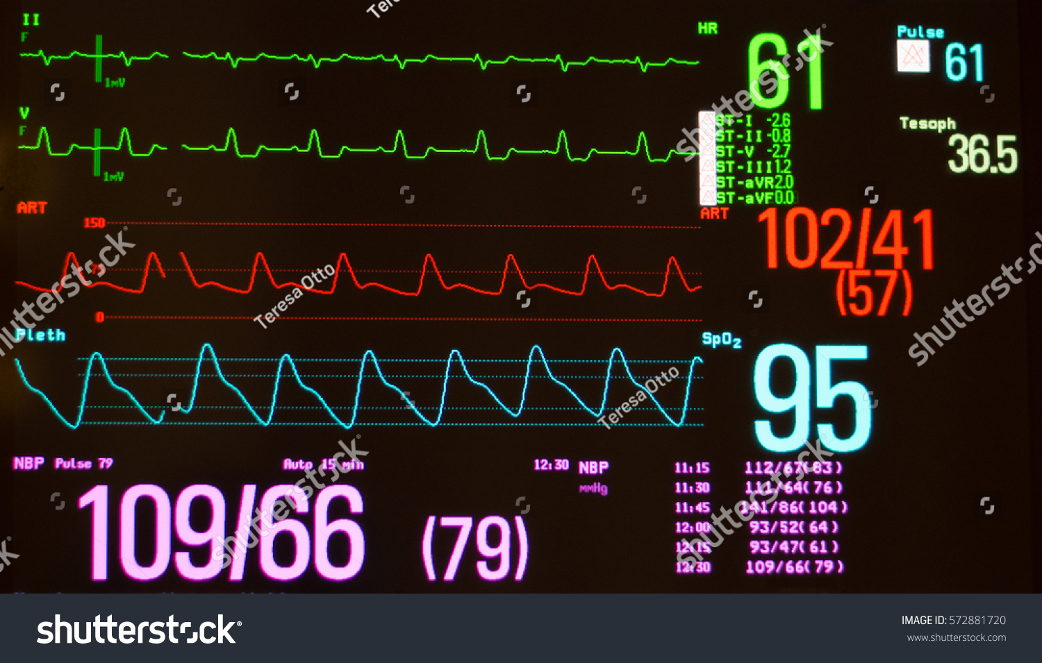 Monitor Black Screen Showing Intraventricular Conduction Stock Photo ...