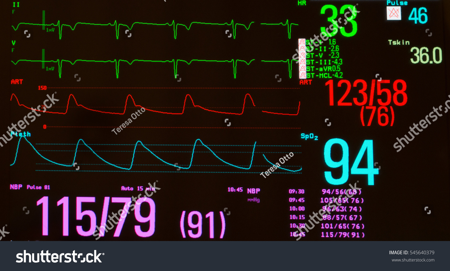 Monitor Ekg Showing Significant Sinus Bradycardia Stock Photo 545640379 ...