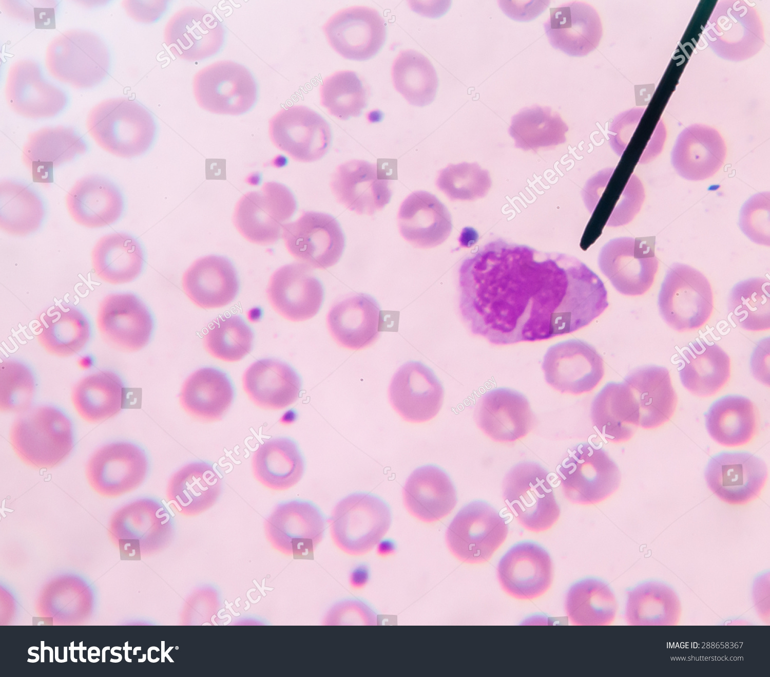 Monocyte Show In Blood Smear Cbc Test Find With Microscope. Stock Photo ...