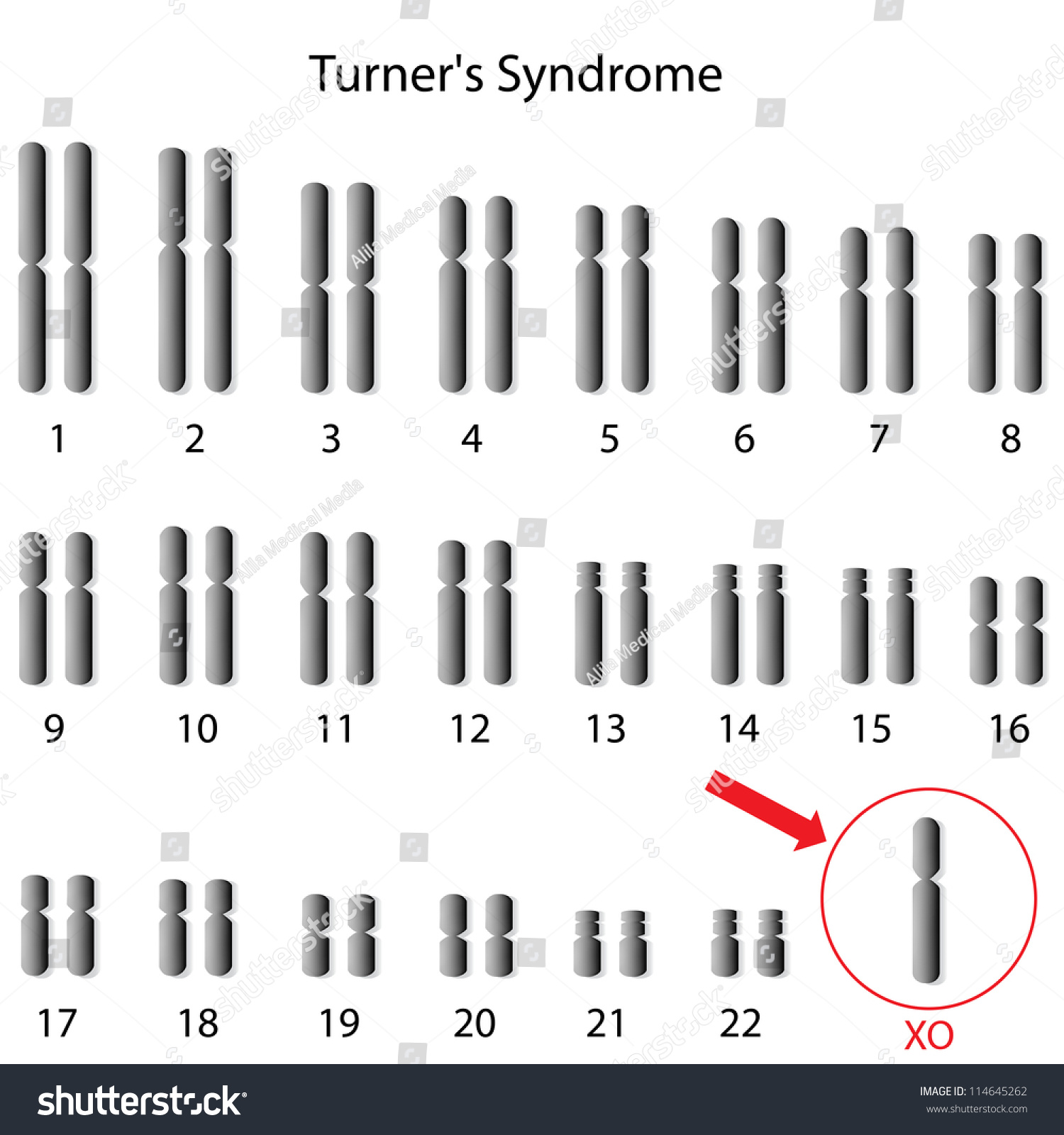 Monosomy X Turner Syndrome Stock Illustration 114645262 Shutterstock