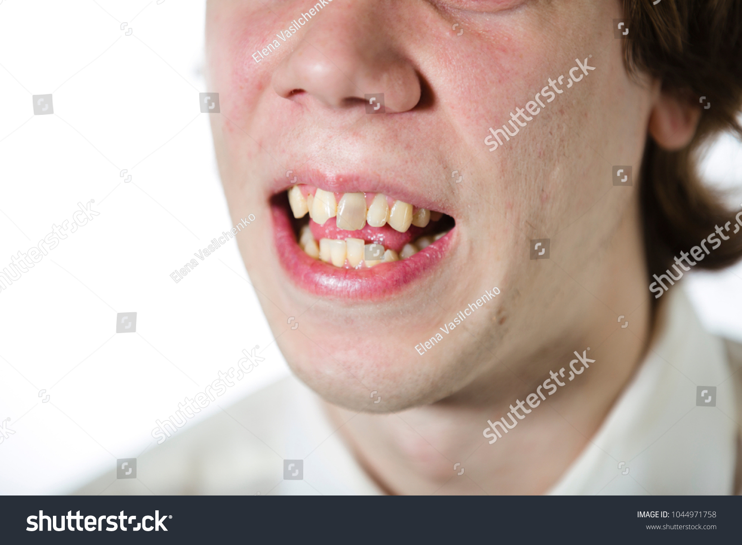 ... (Edit Teeth Now Man Mouth Acne Stock Crooked Yellow Photo