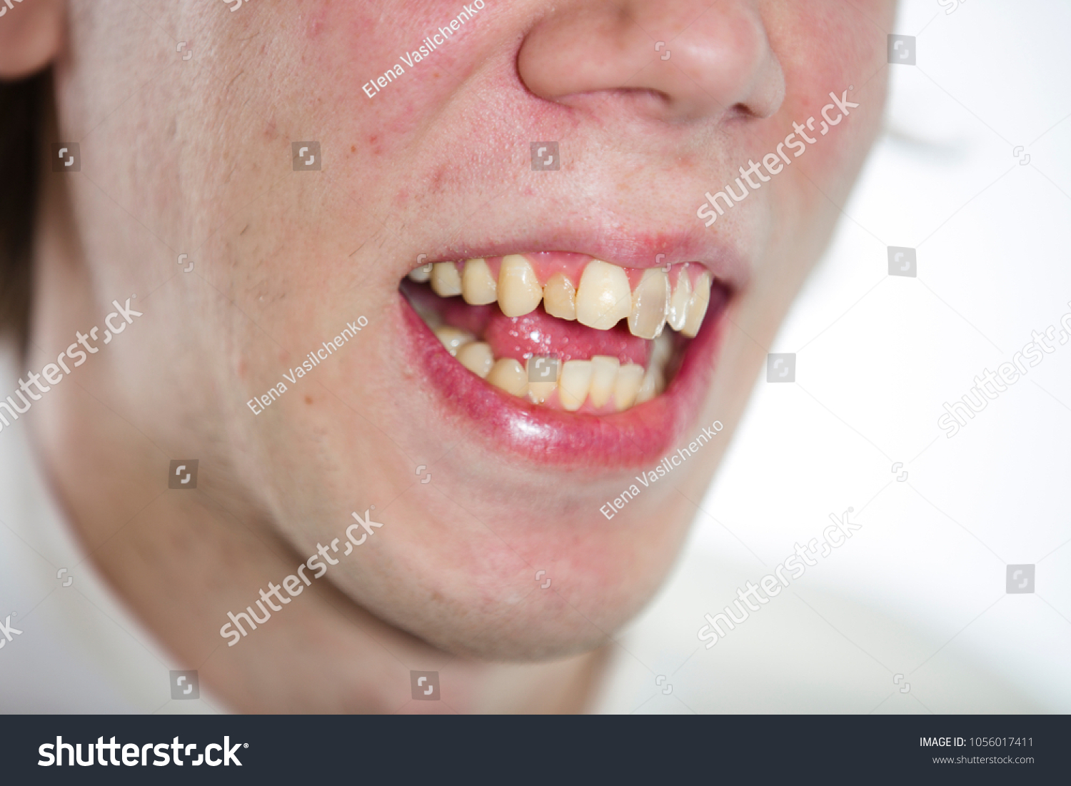 Man Acne ... Mouth Teeth Now Yellow Crooked (Edit Photo Stock