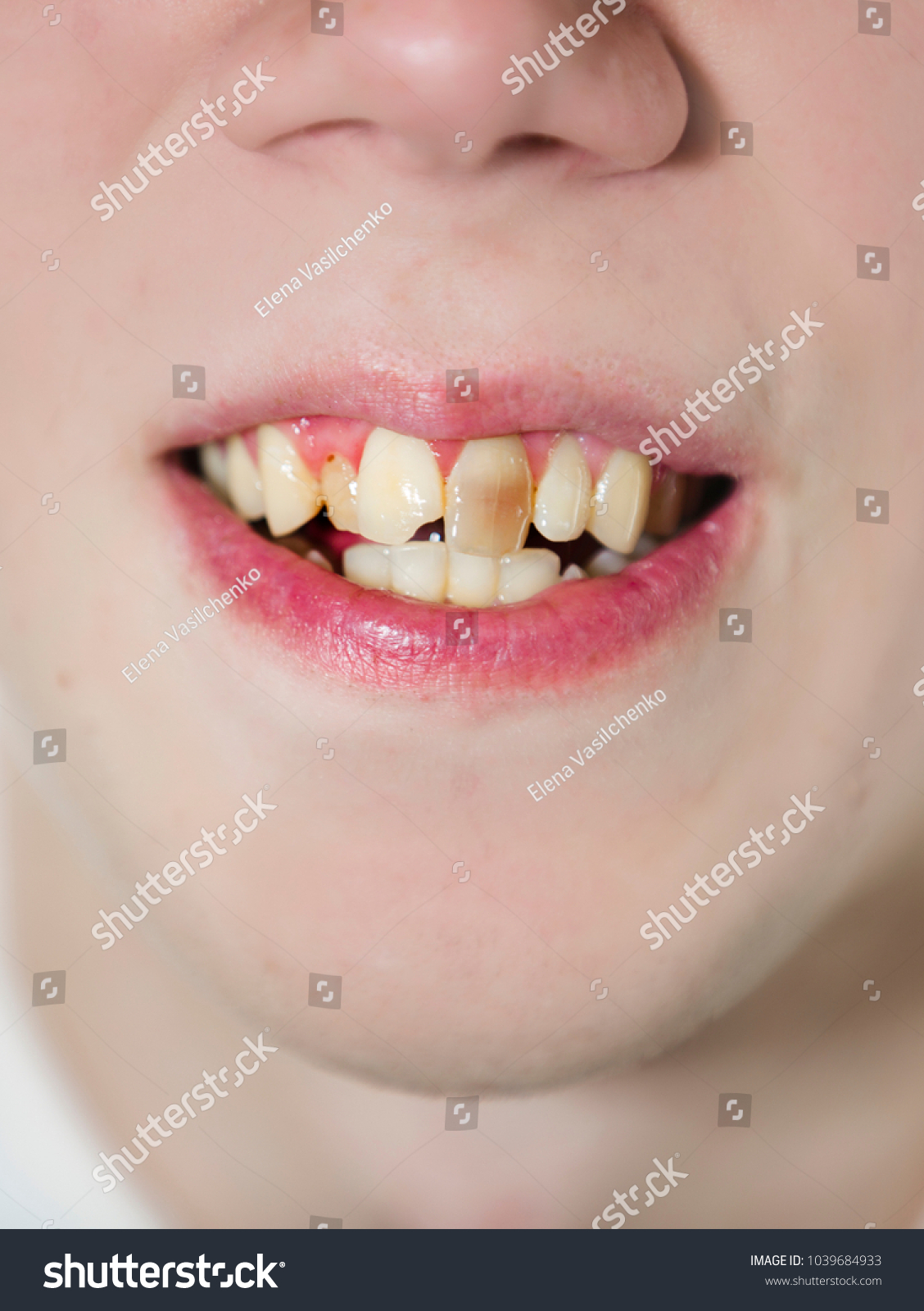 ... Now Yellow Photo Closeup (Edit Man Crooked Mouth Teeth Stock