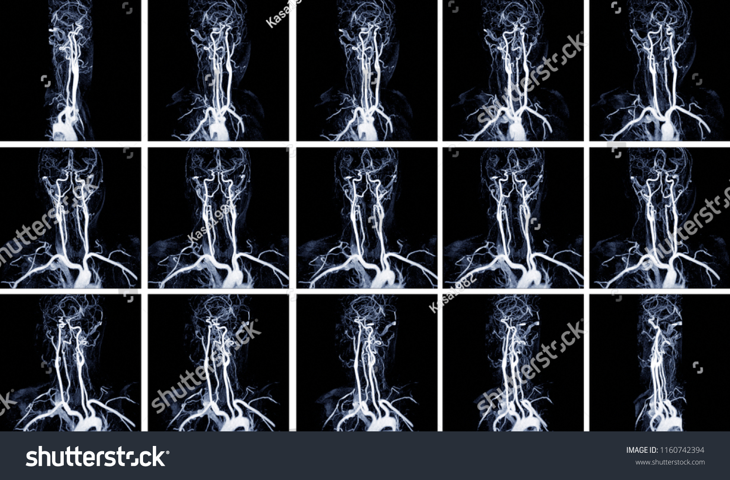 271 Magnetic Resonance Angiography Images Stock Photos Vectors Shutterstock 271 Magnetic Resonance Angiography Images Stock Photos Vectors Shutterstock