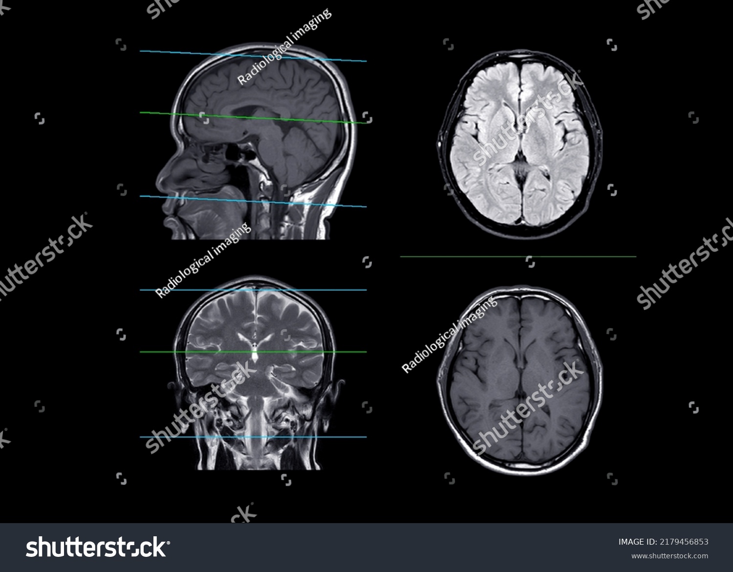 Mri Brain Compare Axial Coronal Sagittal Stock Illustration 2179456853 ...