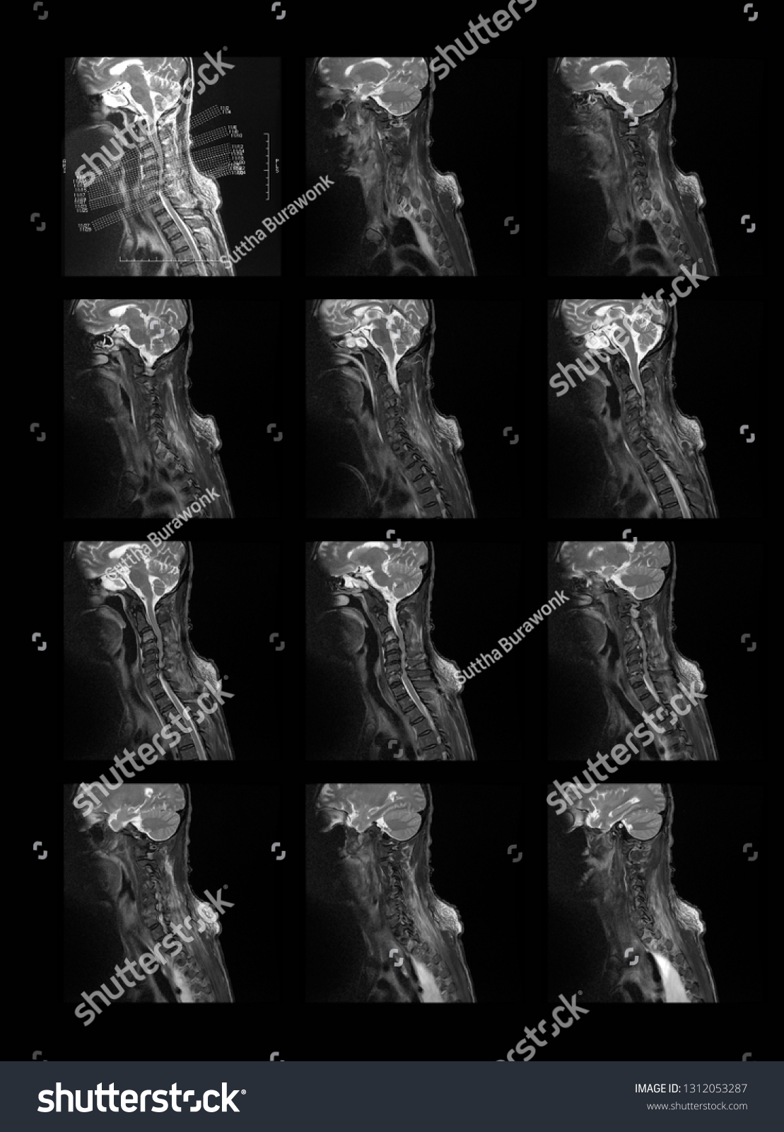 Mri Magnetic Resonance Imaging Cervical Spine Stock Photo 1312053287 Mri Magnetic Resonance Imaging Cervical Spine Stock Photo 1312053287