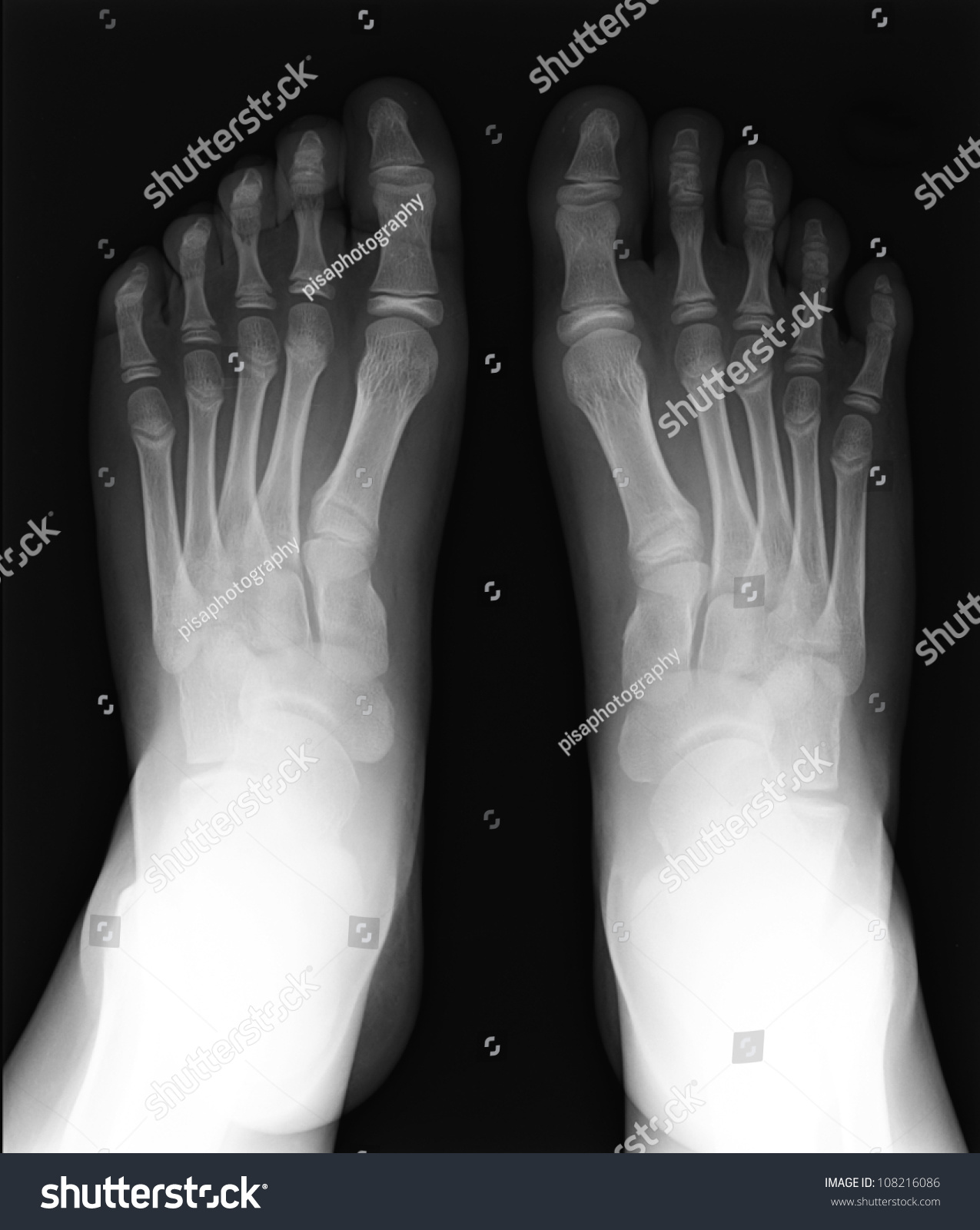 Mri Of Foot Fingers Exposed On X-Ray Black And White Film Stock Photo ...