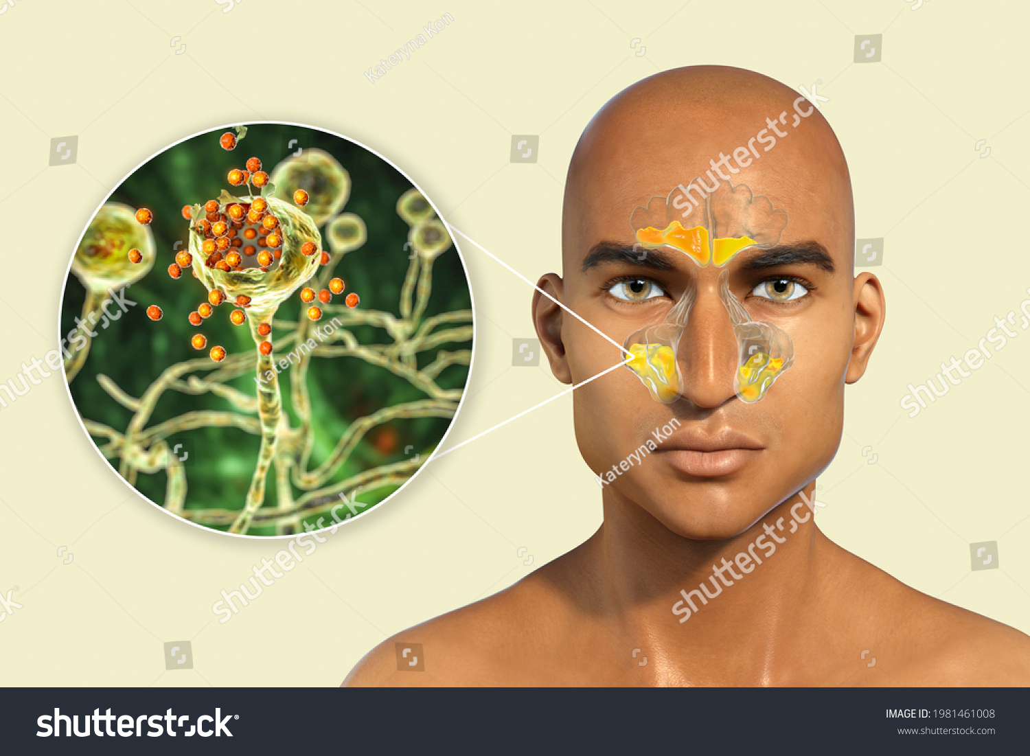 Mucor Fungi Cause Sinusitis 3d Illustration Stock Illustration ...