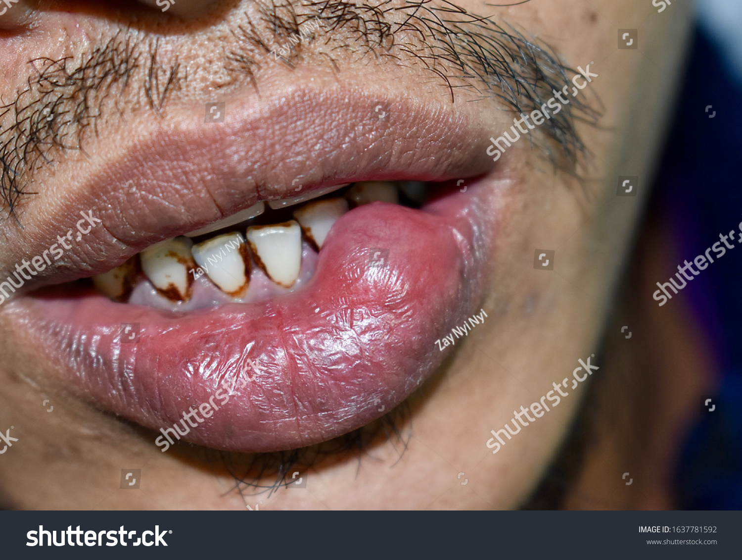 Mucous Cyst Mucocele Lower Lip Southeast стоковая фотография редактировать