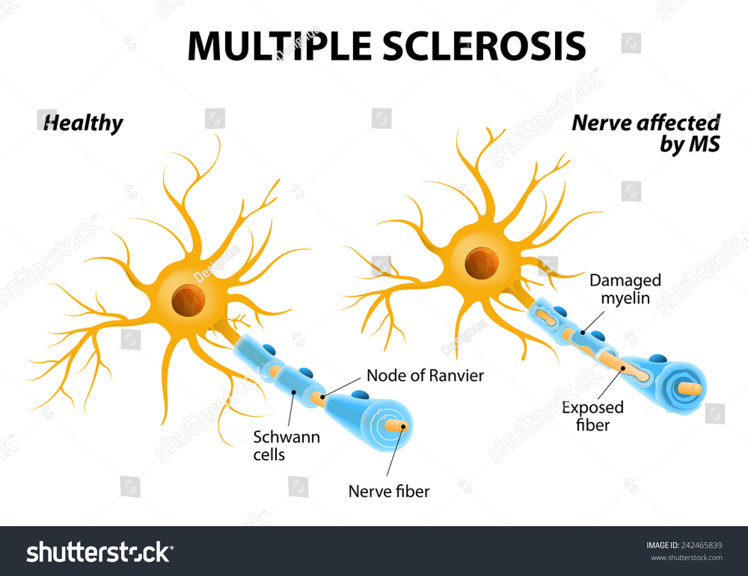 Multiple Sclerosis Autoimmune Diseases