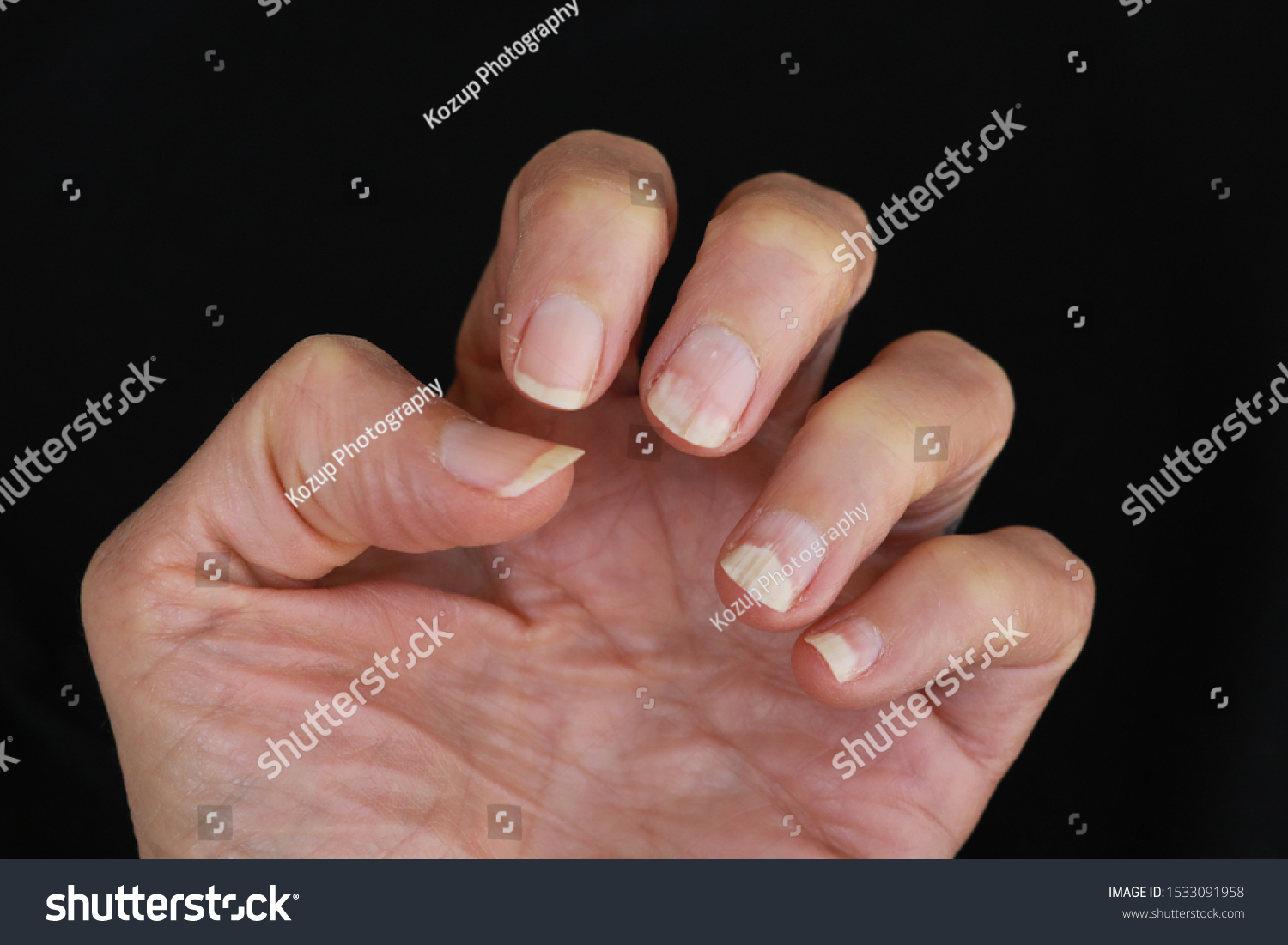 Nail Bed Infection Fungal Abnormality Stock Photo 1533091958 Shutterstock