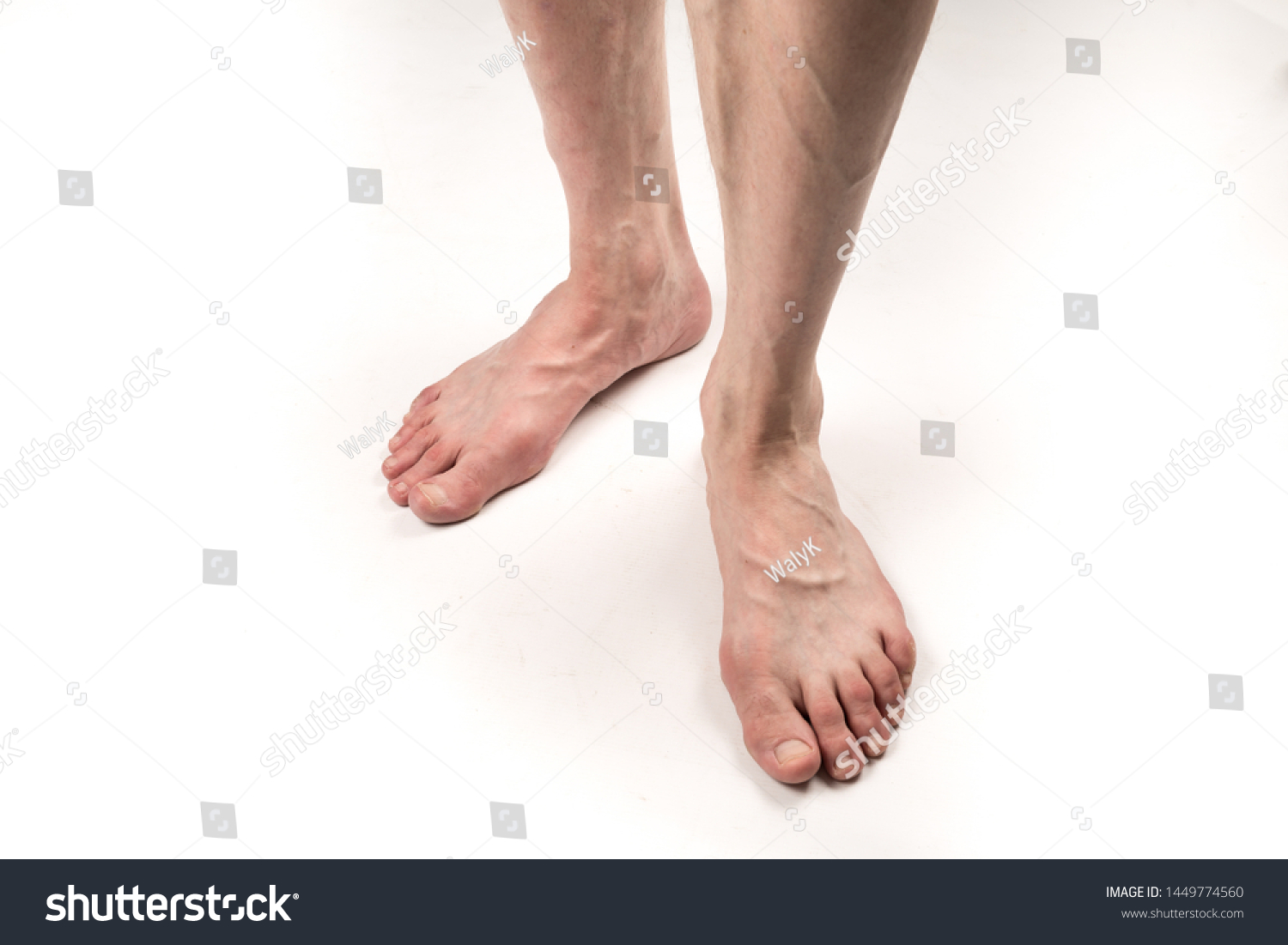 Naked Legs Man Varicose Veins On Stock Photo Shutterstock