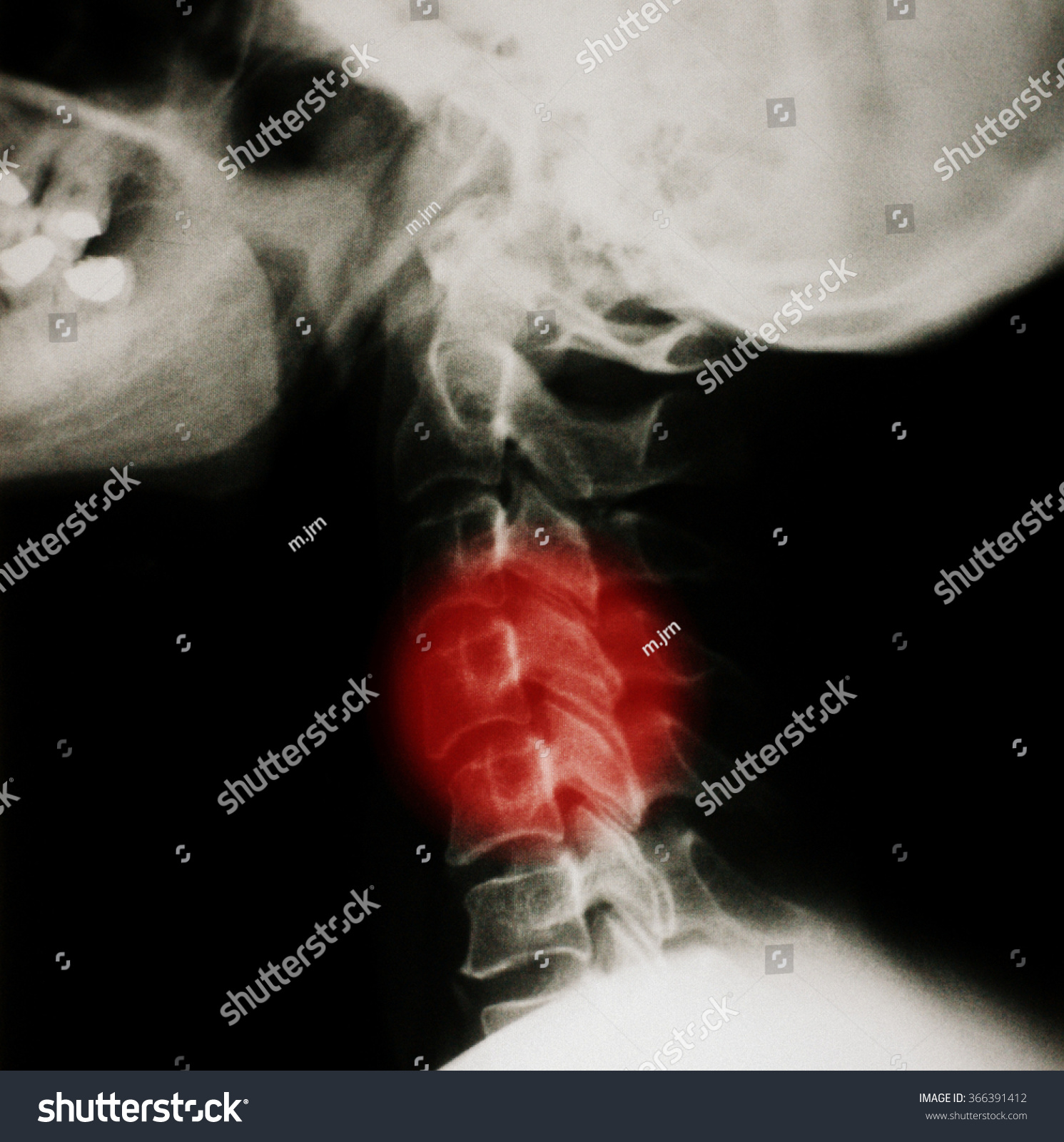 Neck Xray Photo Stock Photo (Edit Now) 366391412