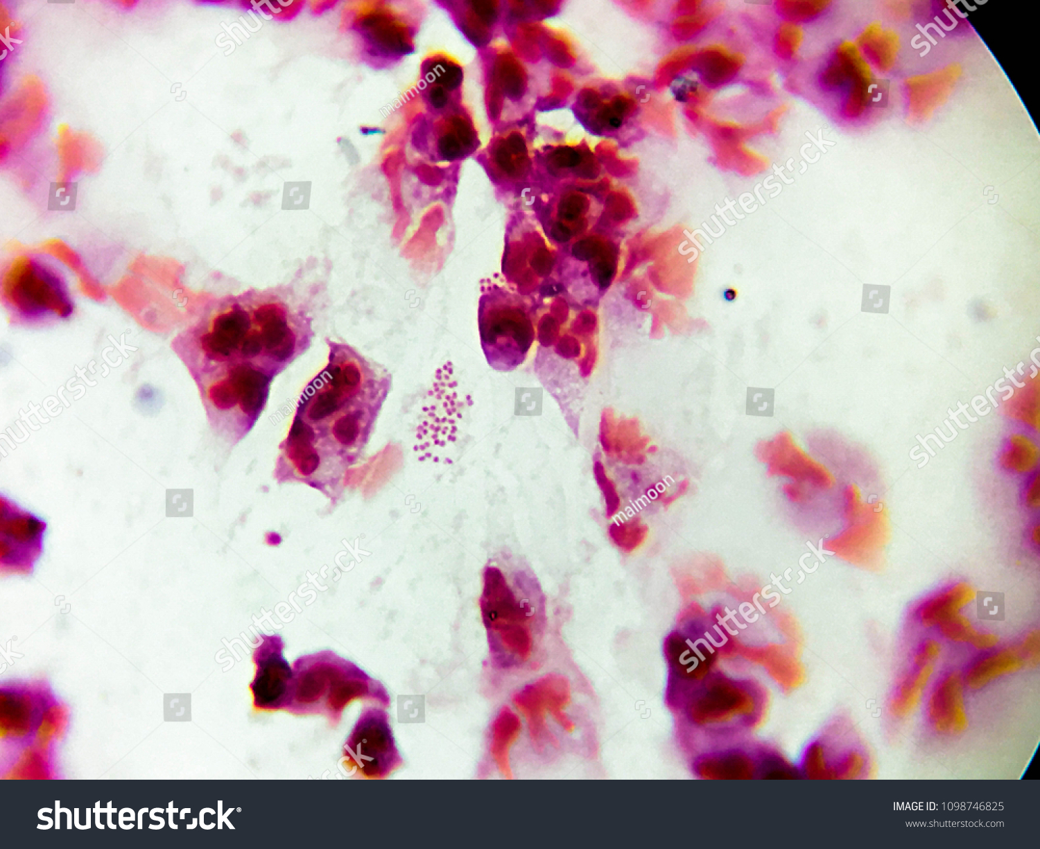 Neisseria Gonorrhoeae Gramstain Gonococcal Urethritis Stock Photo (Edit ...