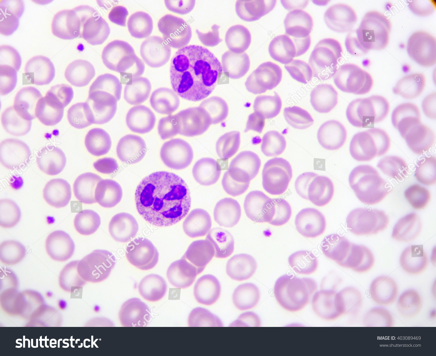 Neutrophil Cell In Blood Smear Stock Photo 403089469 : Shutterstock