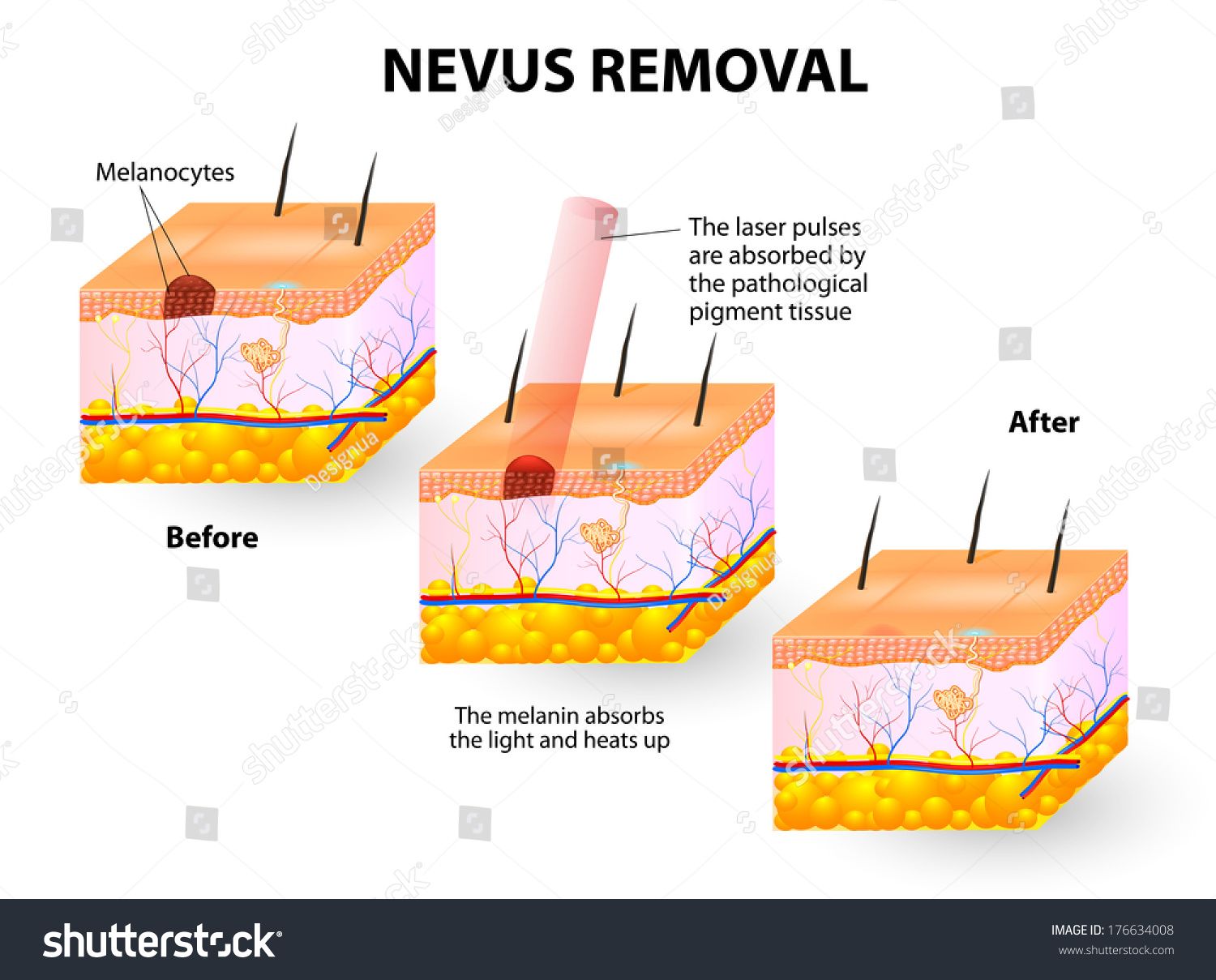 Nevus Removal Stock Photo 176634008 : Shutterstock