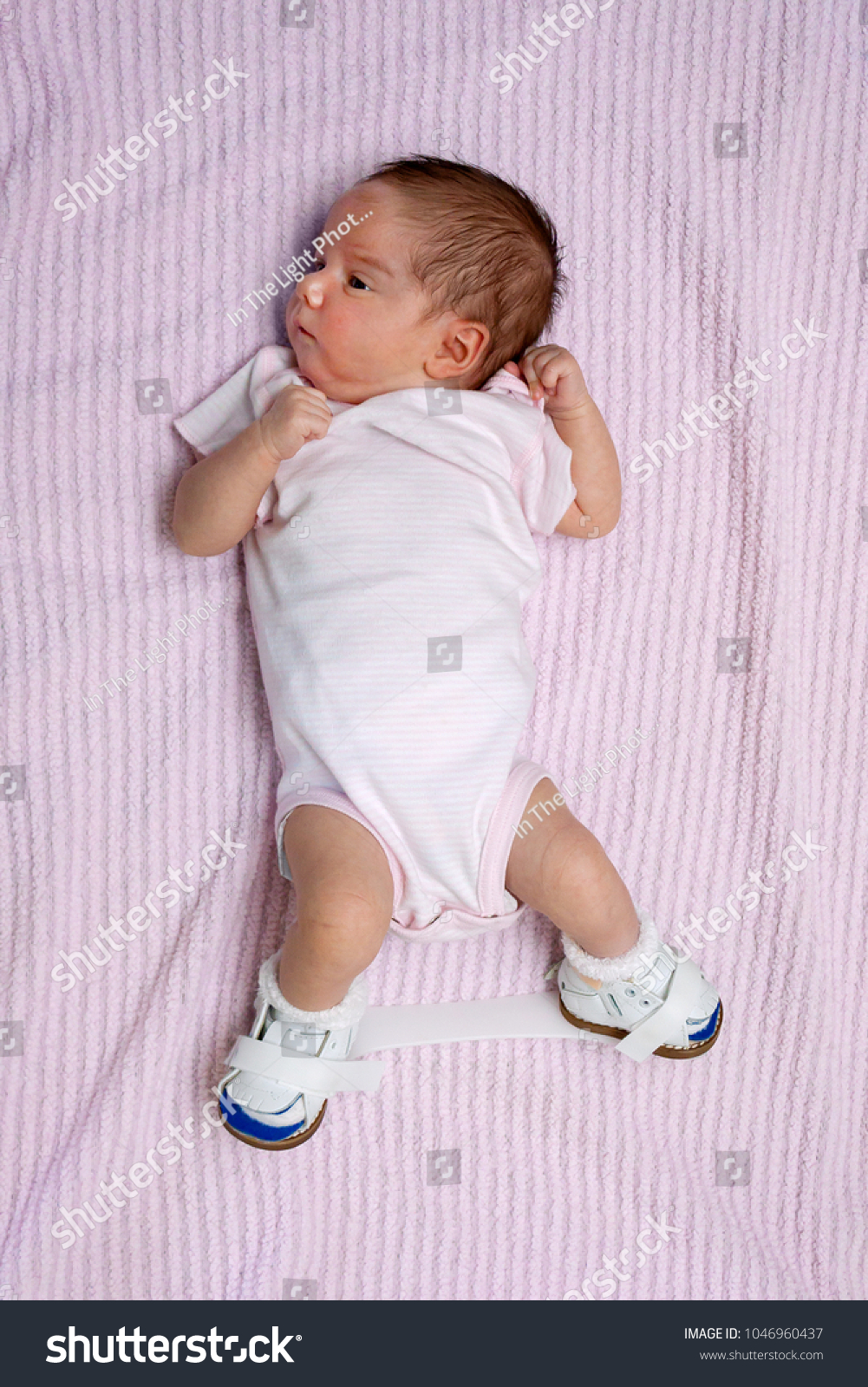 Newborn Baby Club Foot Lays On Stock Photo Edit Now