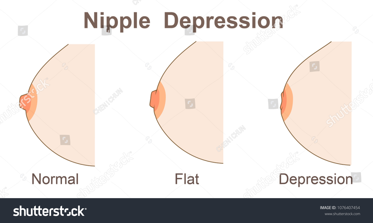 Flat Nipple