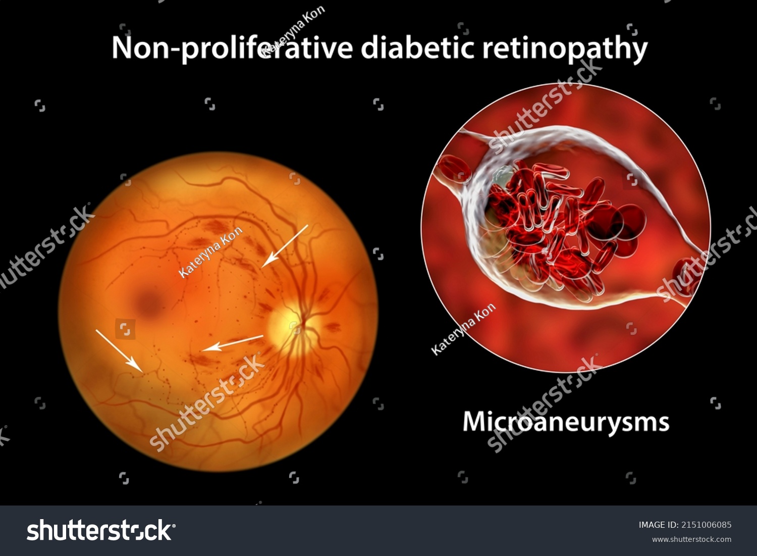 Nonproliferative Diabetic Retinopathy 3d Illustration Showing Stock