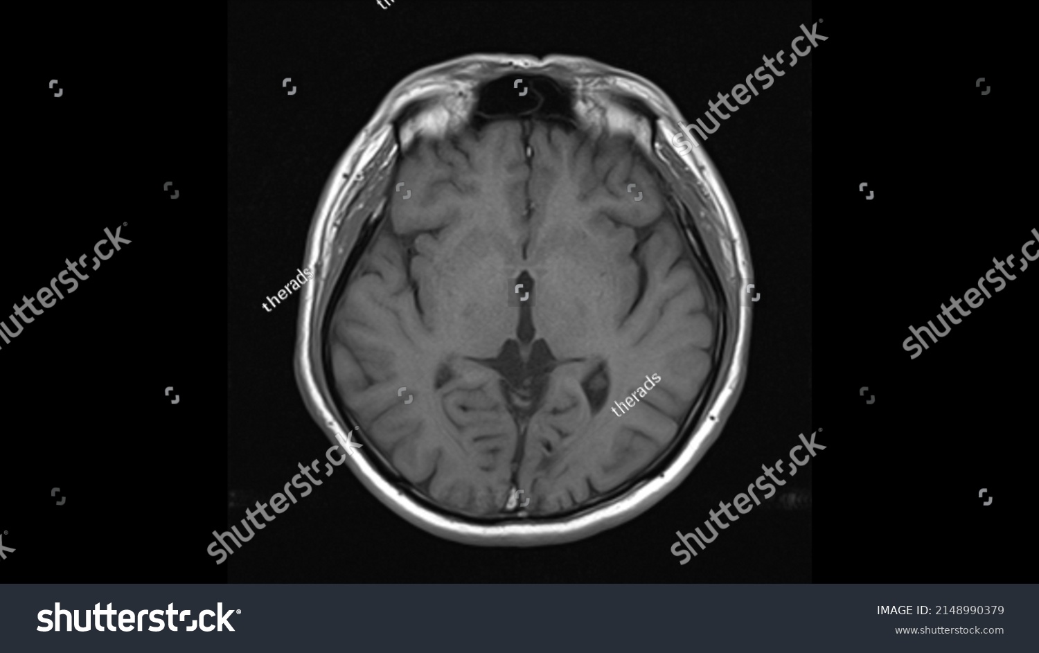 Normal Brain Anatomy Axial T1weighted Mri Stock Photo 2148990379 ...